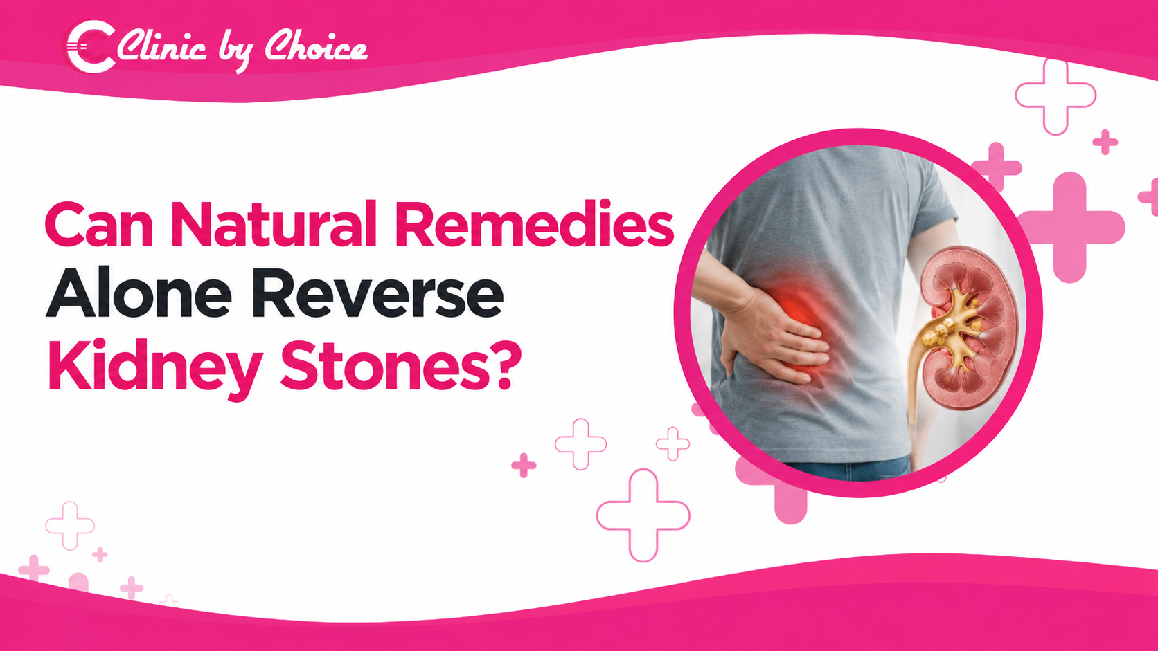 Can Natural Remedies Alone Reverse Kidney Stones?