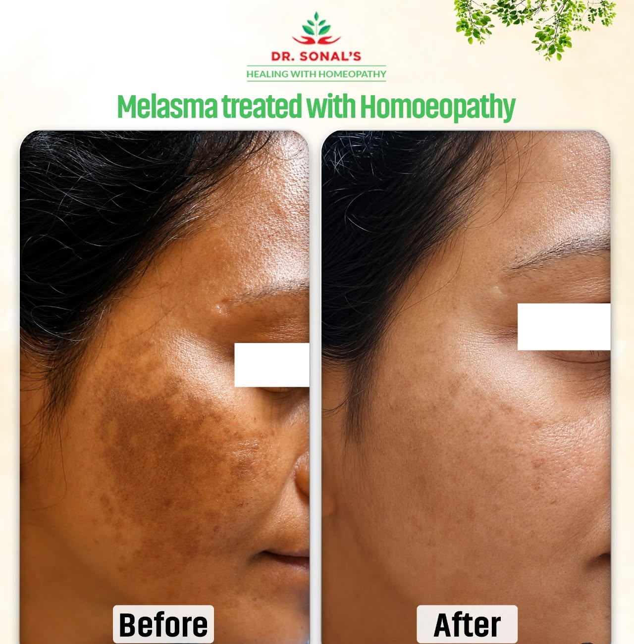 Dr. Sonal's Homeopathic Clinic Melasma treatmemt (1)