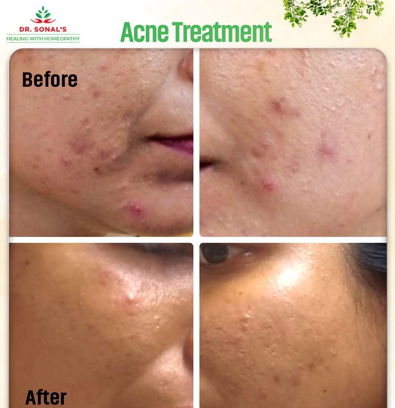 Dr. Sonal's Homeopathic Clinic Acne treatment (1)