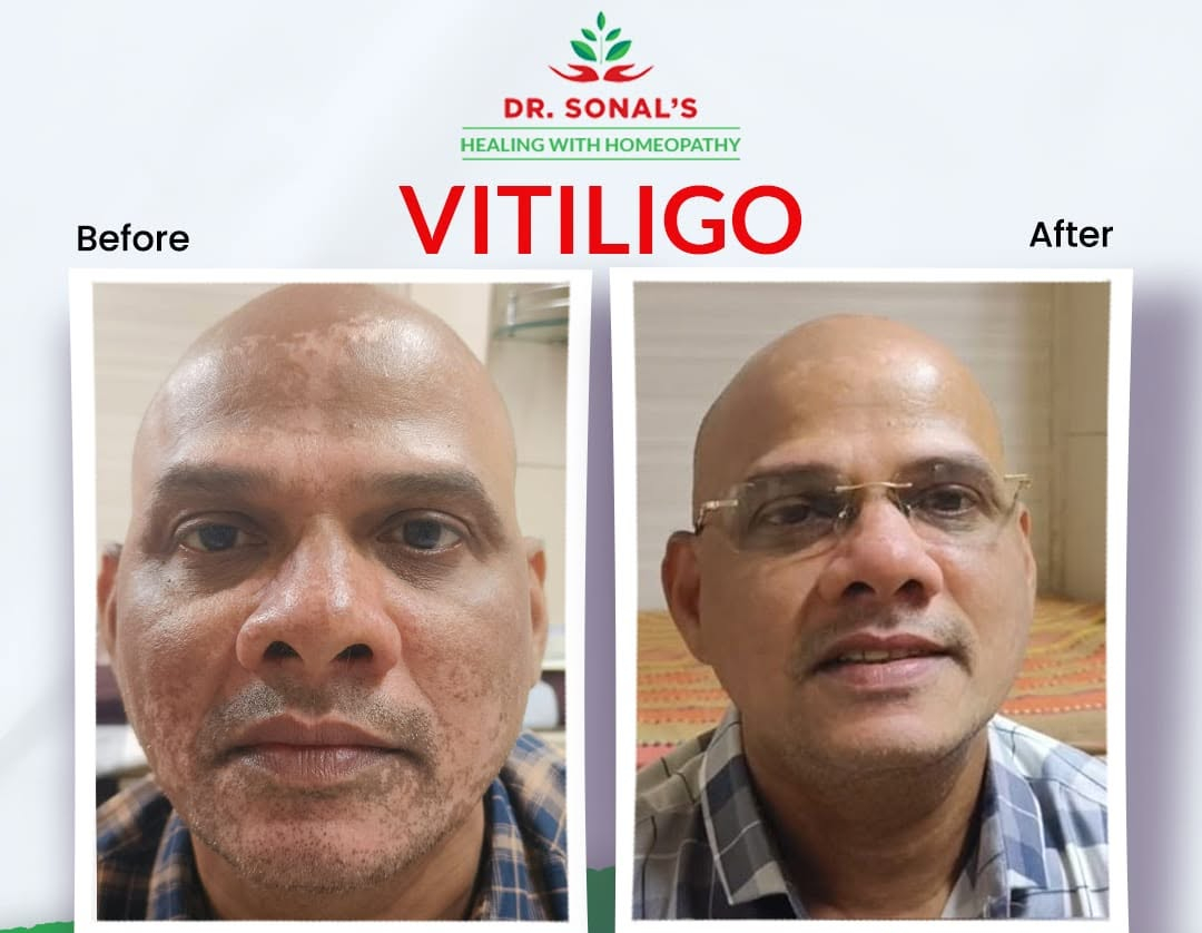 Dr. Sonal's Homeopathic Clinic Vitiligo Treatment (1)