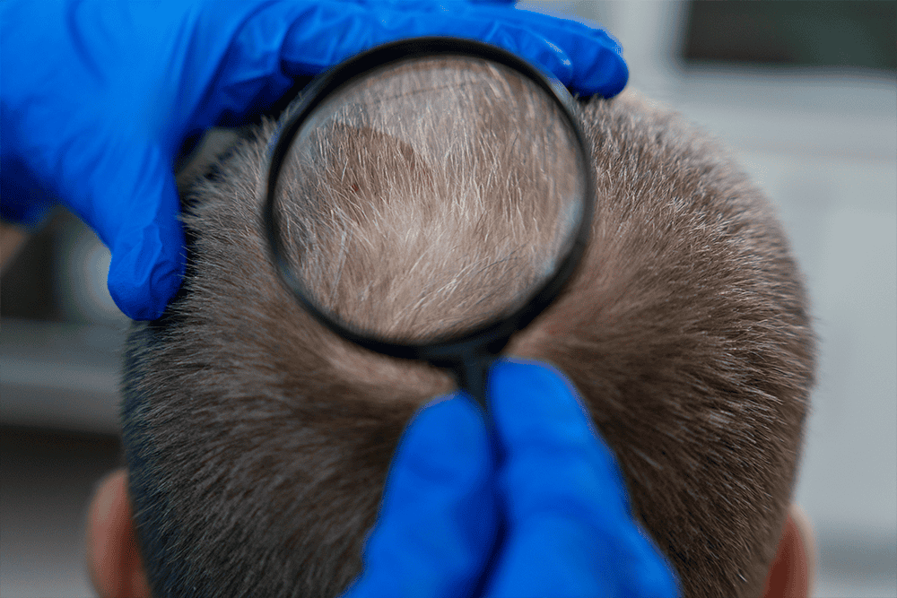 Understand the Determinants Of Male Pattern Baldness