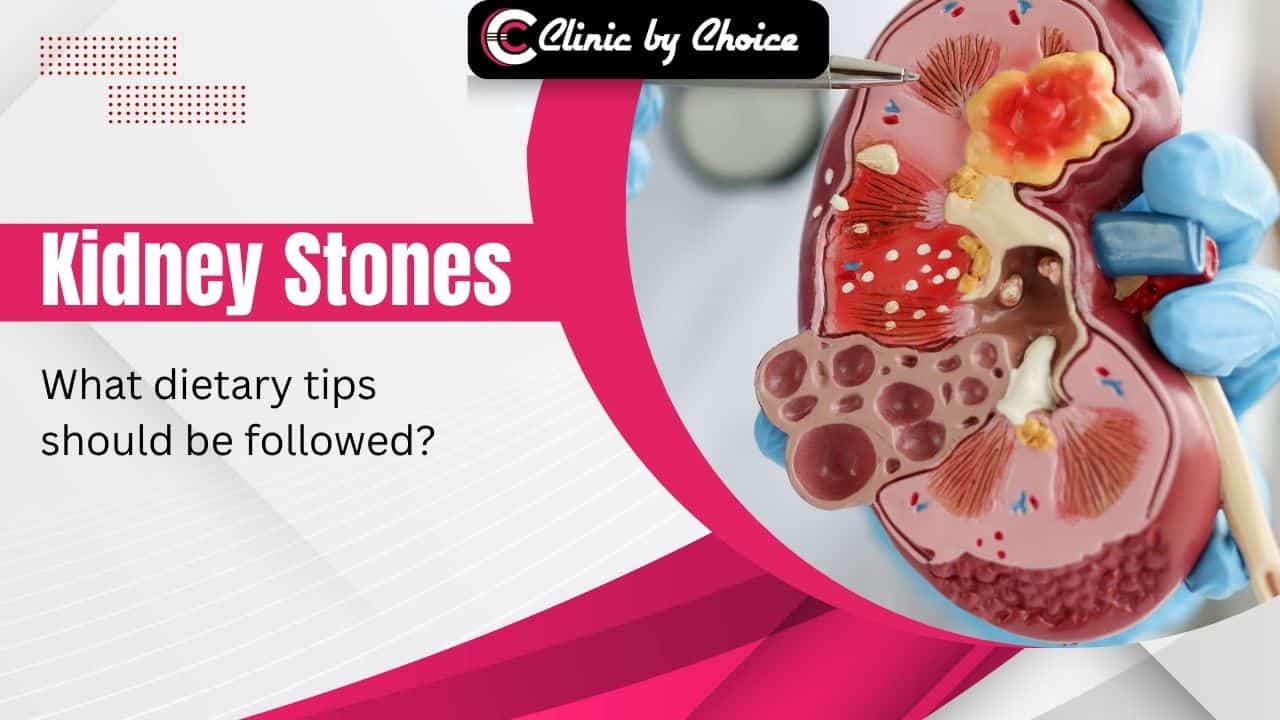 Kidney Stones: What Dietary Tips Should Be Followed?
