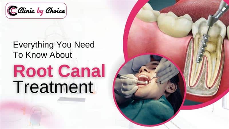 Everything You Need To Know About Root Canal Treatment
