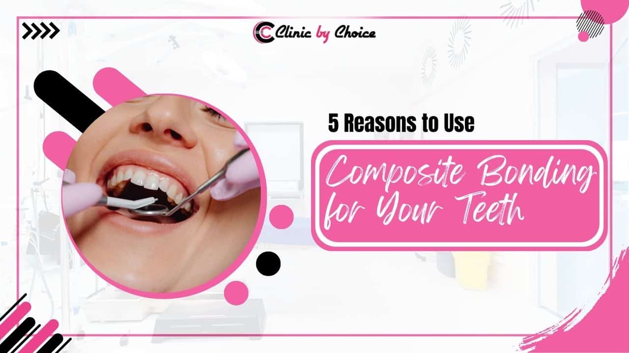 5 Reasons to Use Composite Bonding for Your Teeth